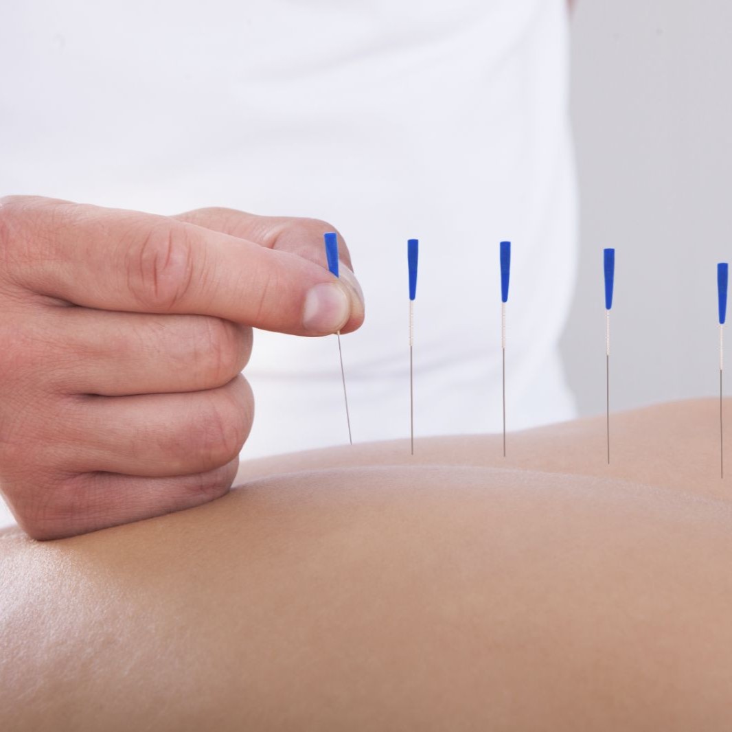 Acupuncture Treatments St Albert